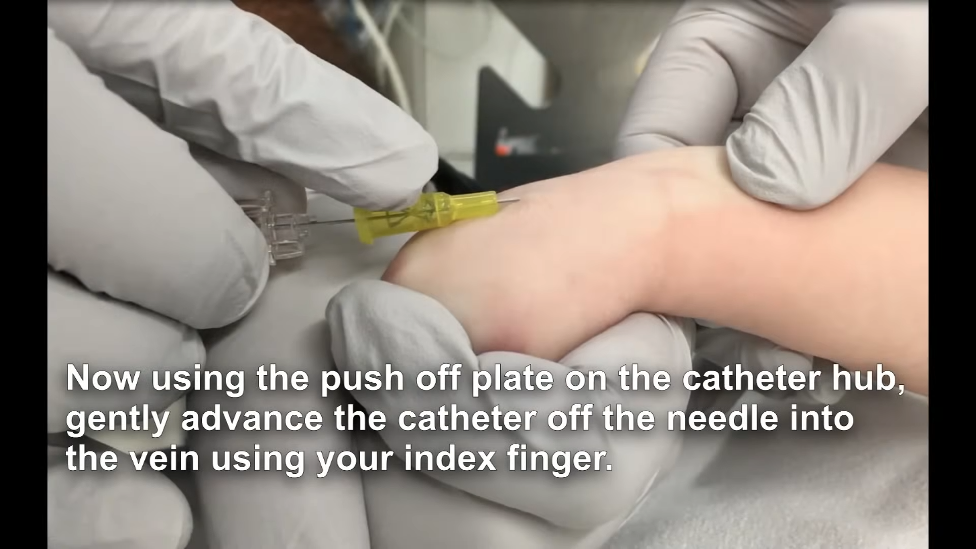 Threading the catheter into the vein